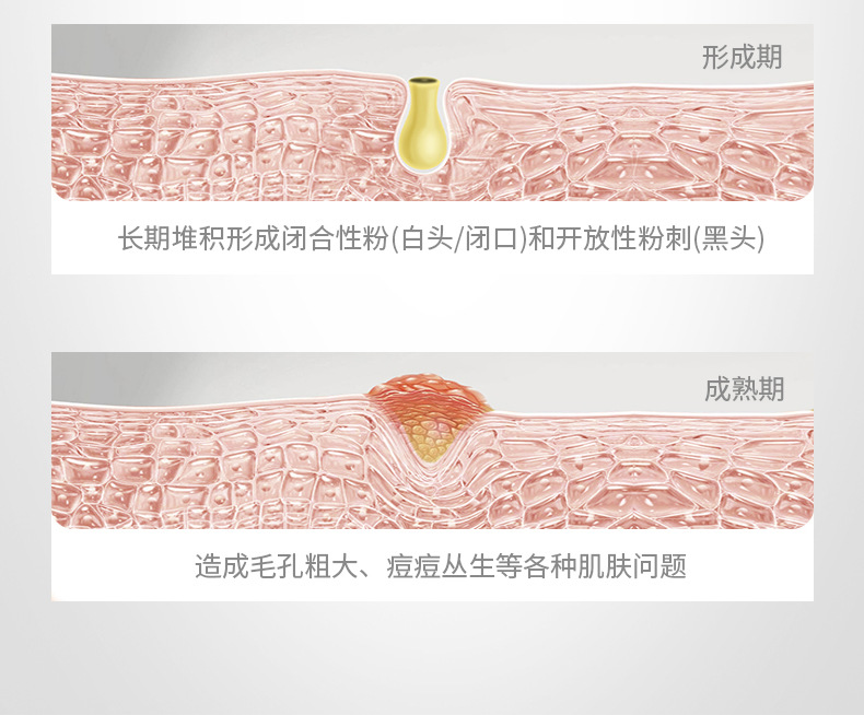 Cleansing Tearing Mask T District Care Acne Removing Blackhead Cutin Brightening Skin Hydrating Cleansing Nasal Membrane Cleansing Tearing Mask T District Care Acne Removing Blackhead Cutin Brightening Skin Hydrating Cleansing Nasal Membrane