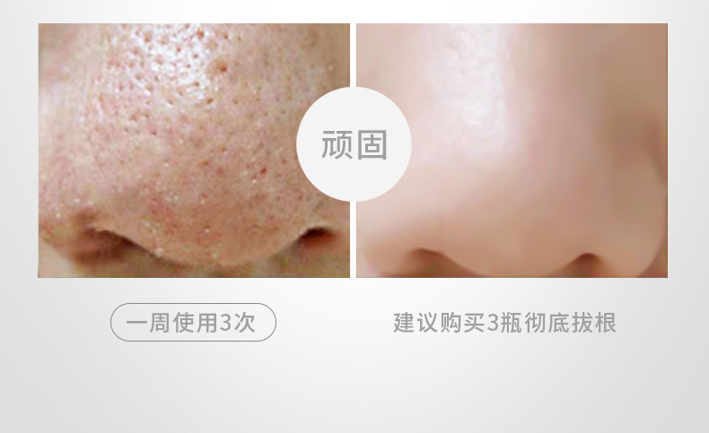 Cleansing Tearing Mask T District Care Acne Removing Blackhead Cutin Brightening Skin Hydrating Cleansing Nasal Membrane Cleansing Tearing Mask T District Care Acne Removing Blackhead Cutin Brightening Skin Hydrating Cleansing Nasal Membrane