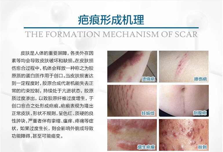 Breathable Silicone Sheet Scar Cesarean Section Transparent Waterproof Scar Paster Surgical Scar Fading Mark 35 12cmoem