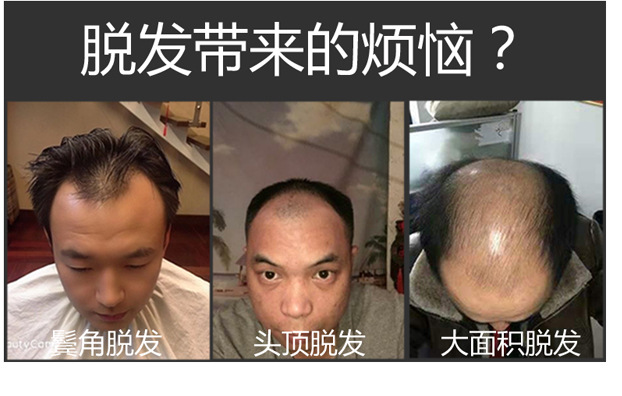 Men's Wig Hair Supplementing Piece Wig Men's Hairpiece Real Hair Bald Men's Hair Replacement Hand Woven Biological Scalp